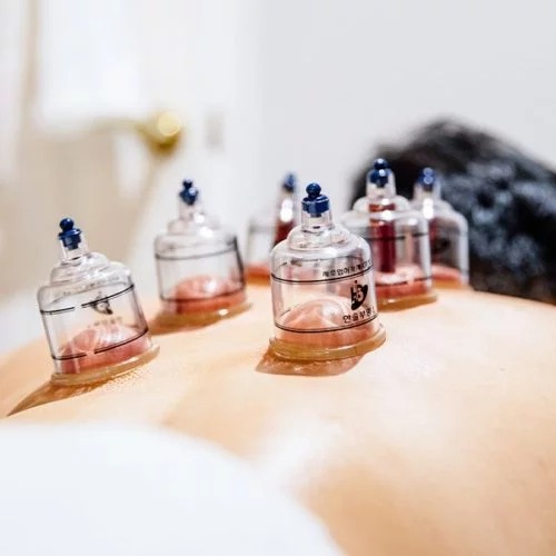 Thérapie par ventouses / Hijama
